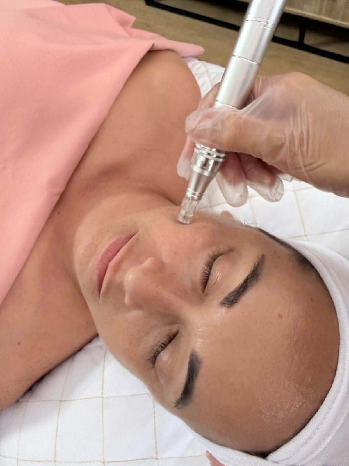 MICRONEEDLING VISAGE